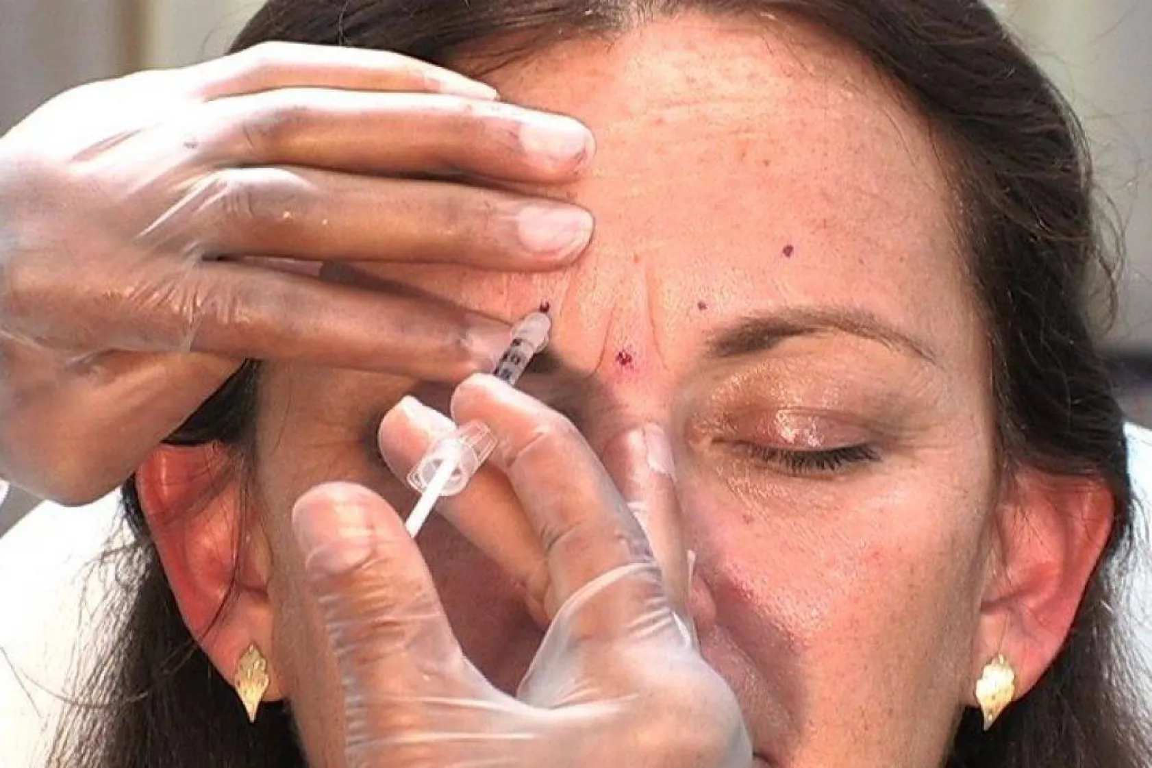 Göz çevresi yaşlanması nasıl önlenebilir?