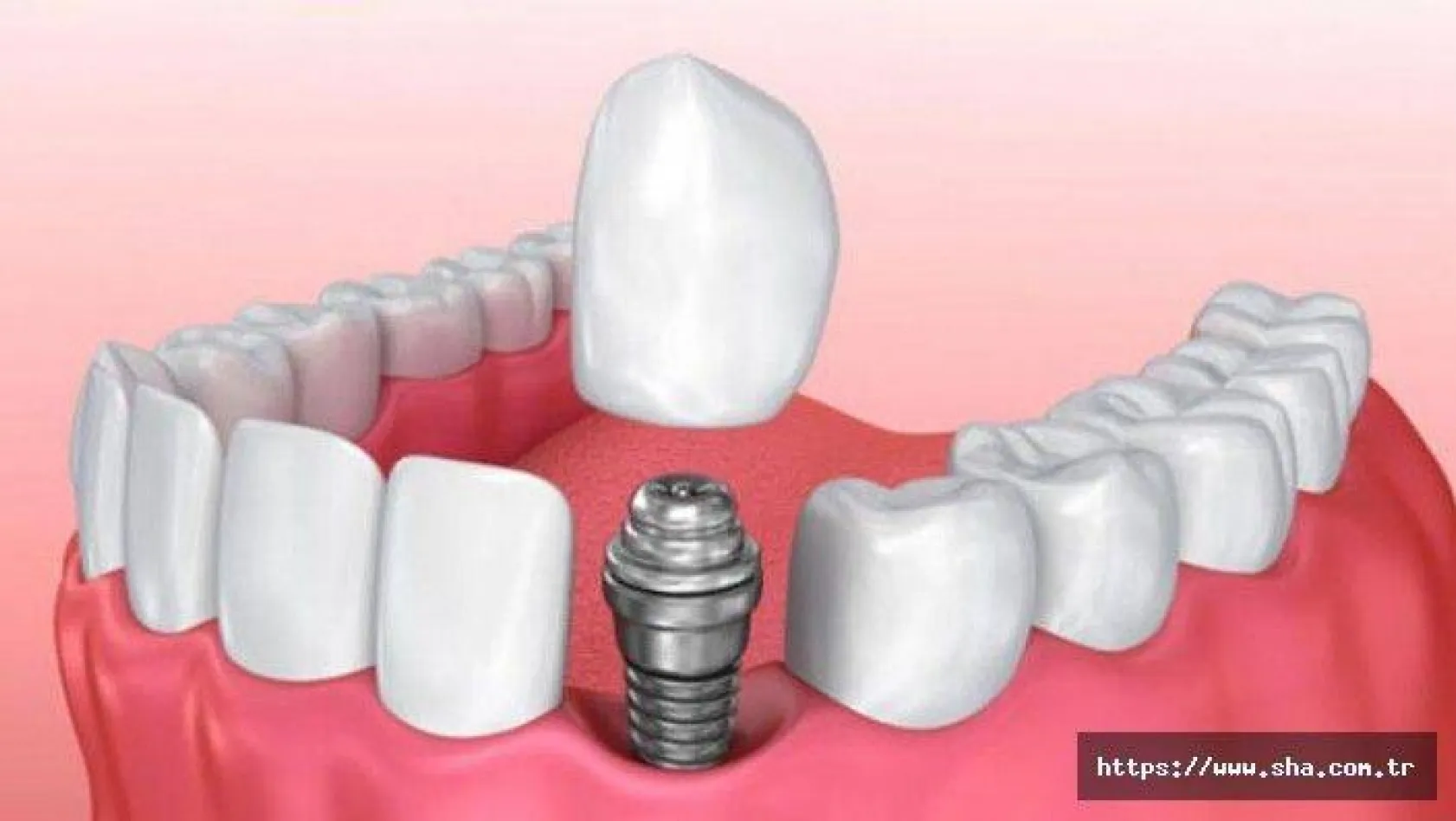 İmplant Tedavisinde Diş Hekimi Seçimi Neden Önemli?