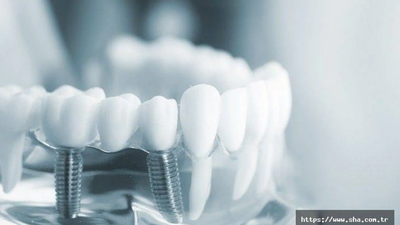 Türkiye'de Diş ve İmplant Tedavisi
