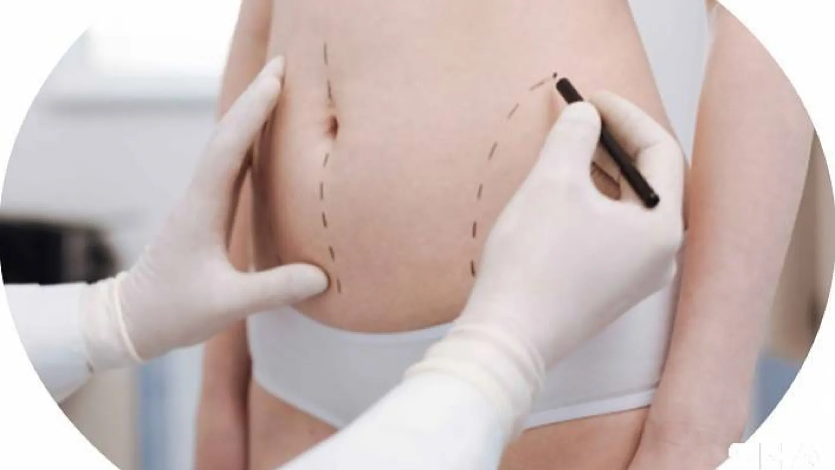 Liposuction Yağ Aldırma Zayıflama Sağlar mı?