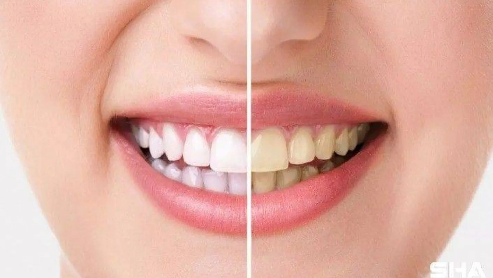 Bilinçsiz yapılan dişlerde ağartma işlemi kalıcı hasarlara neden oluyor