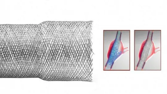 Aort anevrizmasına STENA stent tedavisi