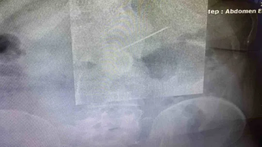 Başörtüsünü bağlarken hapşırınca ağzına aldığı iğneyi yuttu