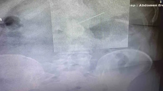 Başörtüsünü bağlarken hapşırınca ağzına aldığı iğneyi yuttu