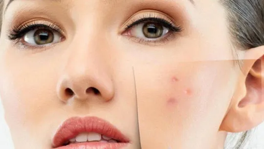 Bu cilt hastalıkları en çok kış mevsimini seviyor!