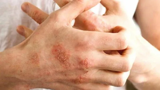 Bu cilt hastalıkları en çok kış mevsimini seviyor!