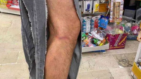 Çankaya'da başıboş köpekler vatandaşın kıyafetlerini parçaladı