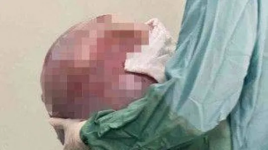 Karnından 35 kilogramlık kitle çıktı