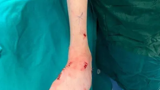 Kazak kardeşler Nuray ve Bota Türkiye'de şifa buldu