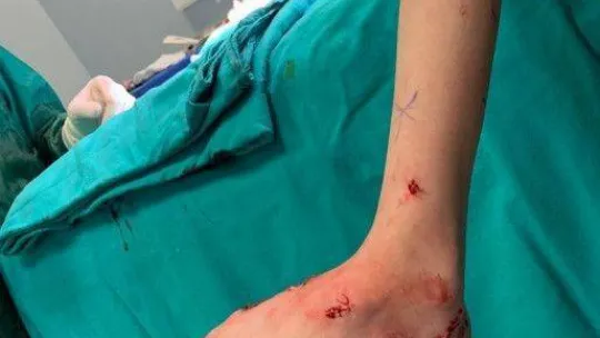 Kazak kardeşler Nuray ve Bota Türkiye'de şifa buldu