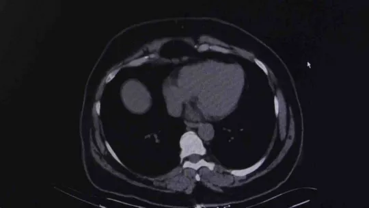 KOAH ataklarına dikkat: 'Şikayetleri sigaraya bağlayarak doktora geç başvuruyorlar'