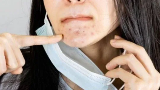 Kurtulduğunuz aknelerin bir daha ortaya çıkabilir