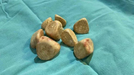 Mesanesinden 550 gram ağırlığında 20 taş çıkarıldı