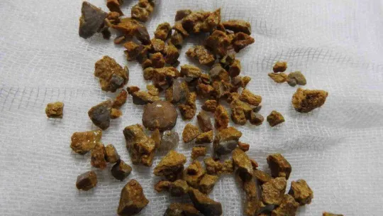 (Özel) Böbreğindeki taş 100 parçaya ayrılarak çıkarıldı
