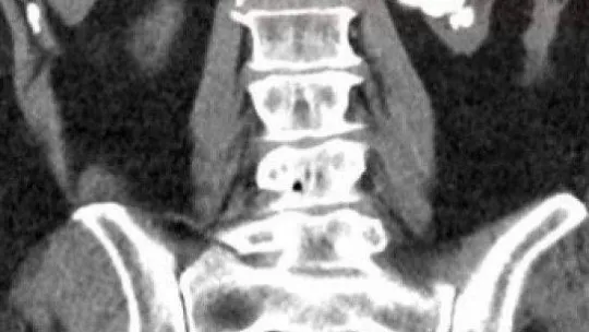 (Özel) Böbreğindeki taş 100 parçaya ayrılarak çıkarıldı