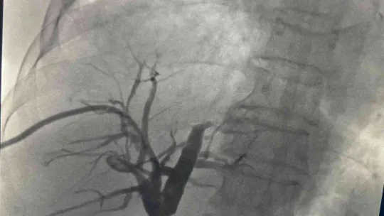 Prof. Dr. Ercan Kocakoç: 'Safra yolu kanserinin ameliyatsız tedavisi mümkün'