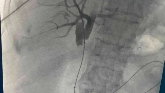 Prof. Dr. Ercan Kocakoç: 'Safra yolu kanserinin ameliyatsız tedavisi mümkün'