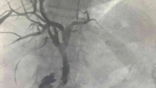 Prof. Dr. Ercan Kocakoç: 'Safra yolu kanserinin ameliyatsız tedavisi mümkün'