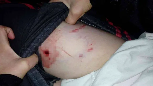 Tekirdağ'da pitbull dehşeti: 10 yaşındaki çocuğu bacağından ısırdı