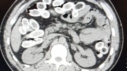 Yalova'da yakalanan Faslı turistin midesinden 1,5 kilo esrar çıktı