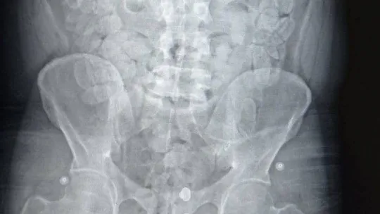 Yalova'da yakalanan Faslı turistin midesinden 1,5 kilo esrar çıktı