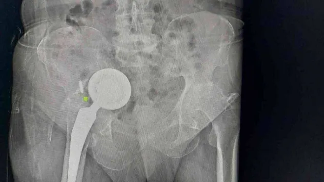 'Ameliyat ol' diyen doktorları dinlemedi, kalça protezi karnından çıktı