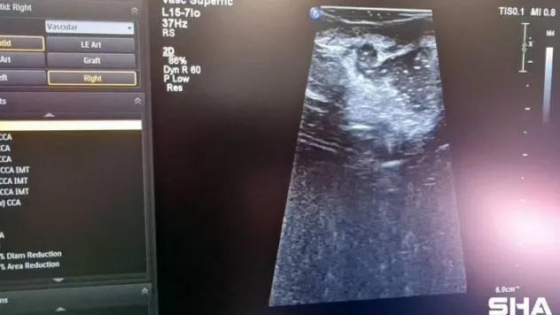 Cumhurbaşkanı Erdoğan'ın açılışını yapmıştı, Hibrit Ameliyathanede ilk ameliyat gerçekleştirildi