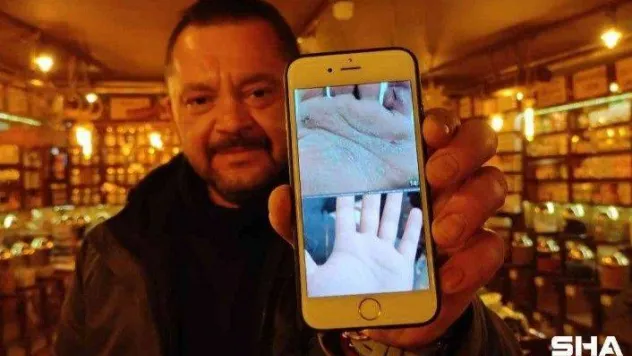 Yaptığı bitkisel karışımla sedef hastalığına çare buldu