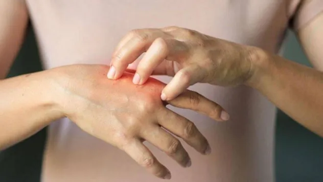 Bu cilt hastalıkları en çok kış mevsimini seviyor!