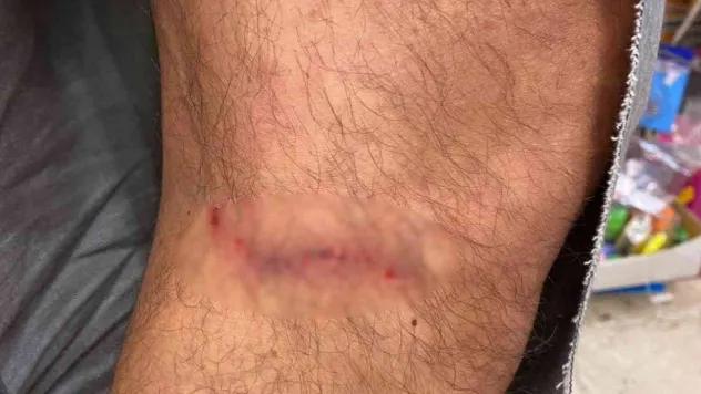 Çankaya'da başıboş köpekler vatandaşın kıyafetlerini parçaladı