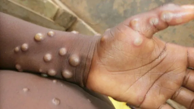 DSÖ, Maymun Çiçeği hastalığını küresel acil durum ilan etti