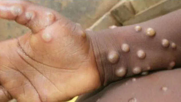 Sağlık Bakanlığı: 'Ülkemizde bugüne kadar 'maymun çiçeği' vakası görülmemiştir'