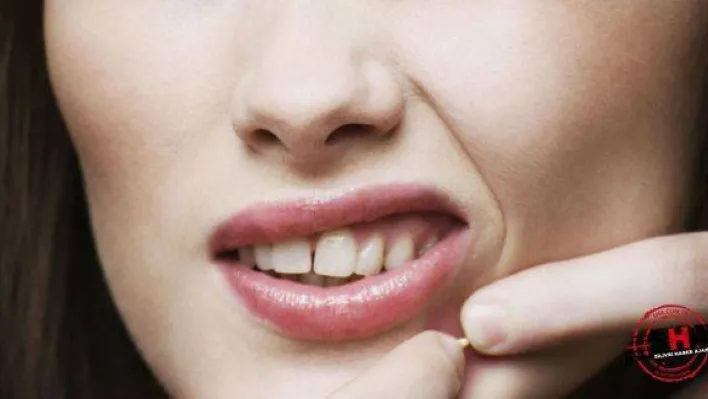 Sivilce nasıl geçer, doğal tedavi yöntemleri nelerdir?