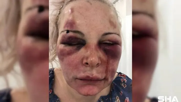 Otel odasında günlerce darp edilen Rus kadın konuştu: 'Yaşamla ölüm arasındaydım'