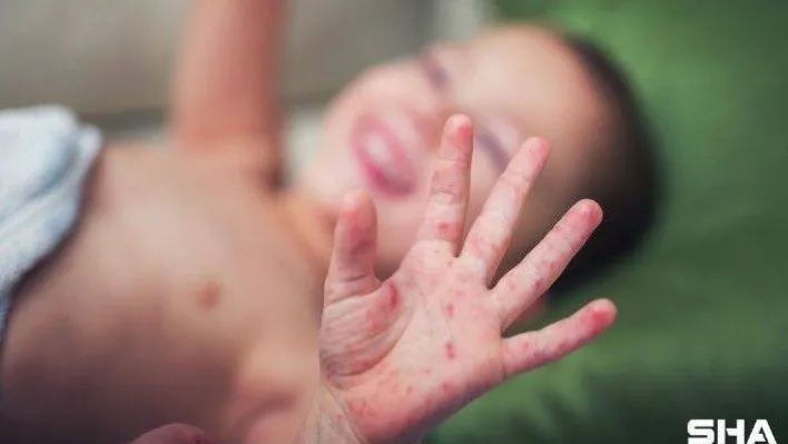 Bu hastalık hem çocuklar, hem de aileler için kabus oluyor