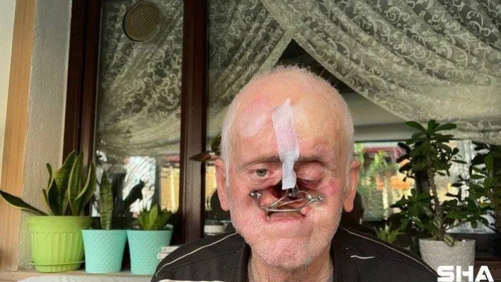 Burnu her gün milim milim eridi, 31 ameliyat geçirdi