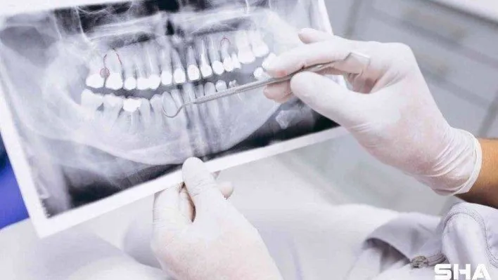 Sigara, diş tedavi sürecini olumsuz etkiliyor
