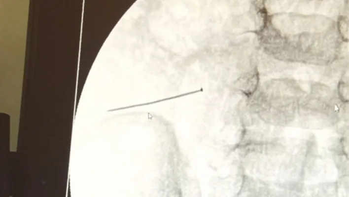 Ağrıyla kıvranan 2 yaşındaki çocuğun bağırsağından 3 santimlik iğne çıktı