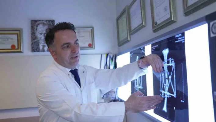 Boy kısalığına karşı modern çözüm: kemik uzatma yöntemleri