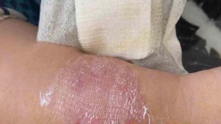 Büyükçekmece'de sigara dumanı tartışmasında kolunu ısırdı