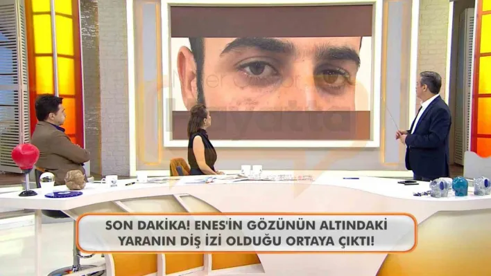 Canlı yayında Enes Güran'ın gözünün altındaki diş izine dikkat çekildi