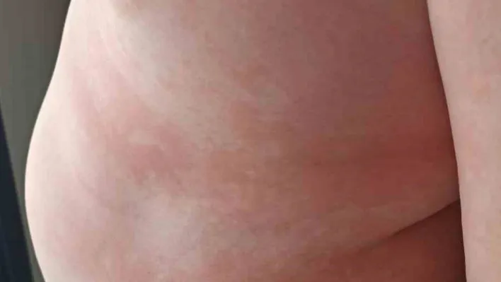 Çocuklarda besin alerjilerine dikkat: 'Yiyeceklerin içeriği sorgulanmalı, anafilaksi hayatı tehdit edebilir'