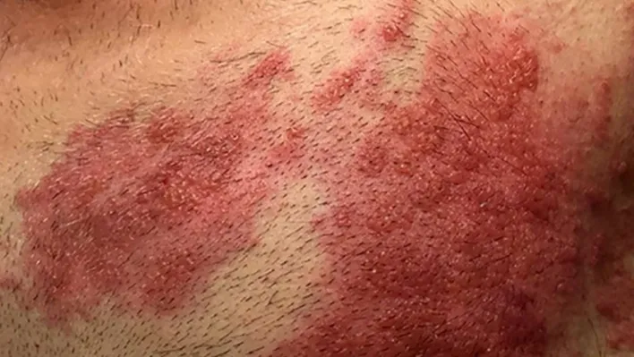 Covid-19 salgını sonrası viral hastalıklar coştu: Kızamık ve Zona'ya dikkat