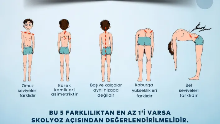 Skolyoz Erken Teşhisle Önlenebilir!