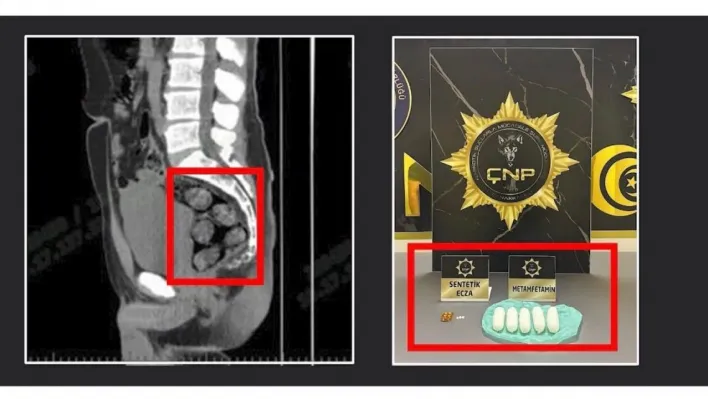 Tomografide şok eden görüntü...Uyuşturucu midesinden çıkarıldı