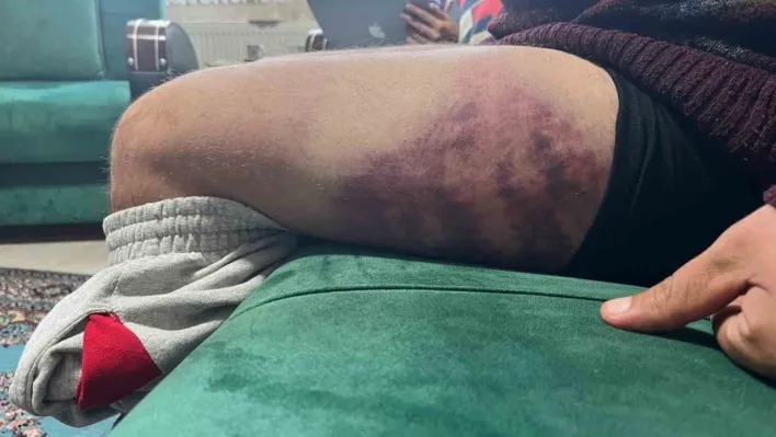 Vicdanları yaralayan olay: Otizmli şahıs odunluğa baktı diye odunla darbedildi