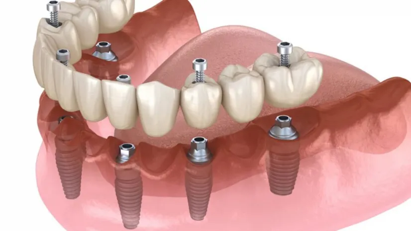 All On 6 Dental Implants in Antalya: A Permanent Solution for Missing Teeth